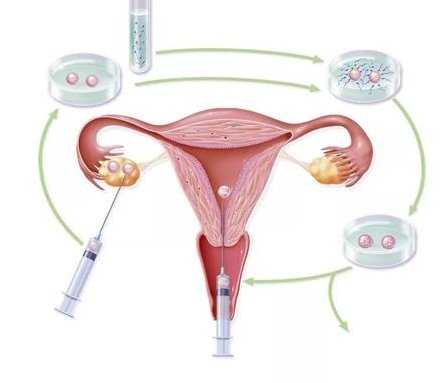 从江苏去柬埔寨做试管费用是多少？